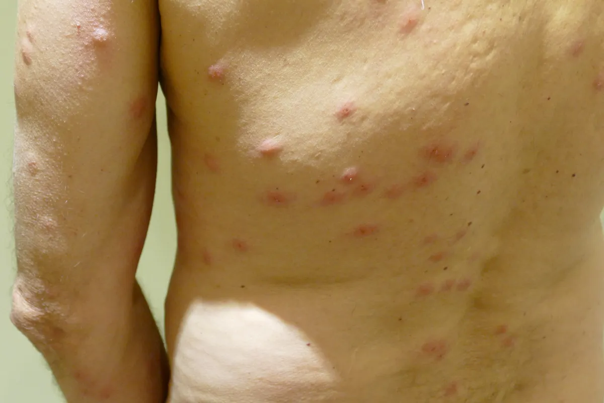 A man's bare back and upper arm dotted with many raised red bumps, some in short rows and small clusters
