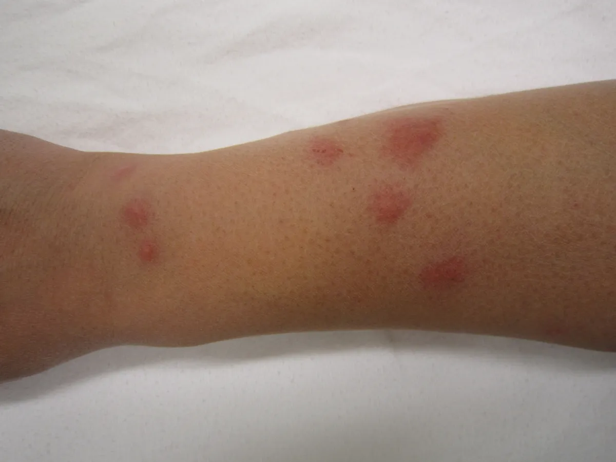 Several raised red welts of different sizes scattered along a forearm resting on a white sheet.