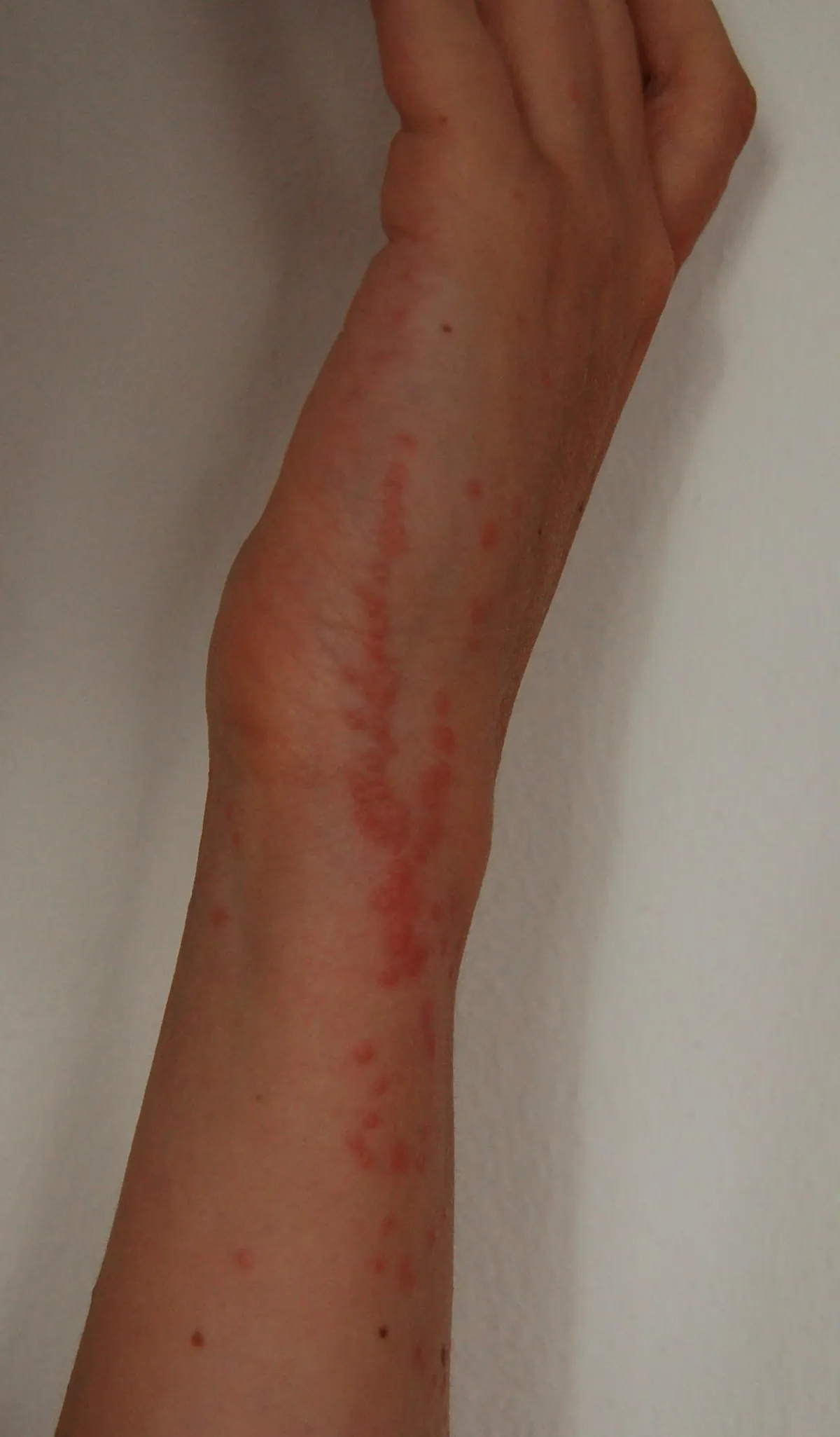 A row of small red bites along the outside of a wrist and forearm, attributed to bed bugs by the photographer