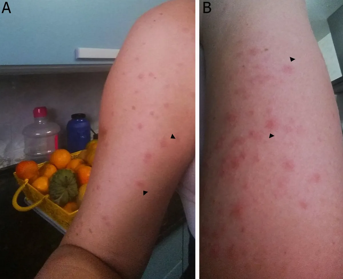 Two views of a person's arm dotted with many small red bumps, with black arrows pointing to some of them, beside a kitchen counter