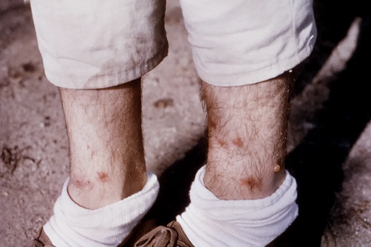 Several red bumps on the lower legs and ankles of a man, just above white socks rolled down over his shoes.