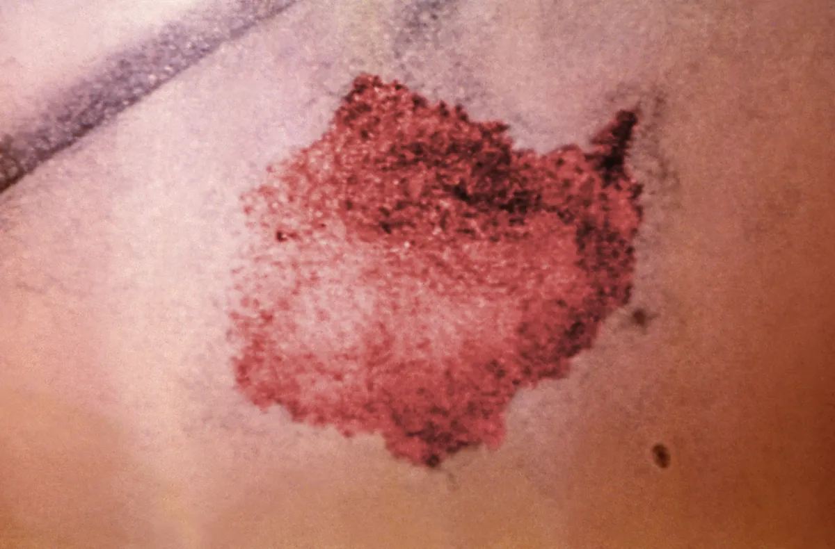 Irregular patch of red, blotchy skin with darker red and purplish spots, mostly along its upper edge, around a brown recluse bite
