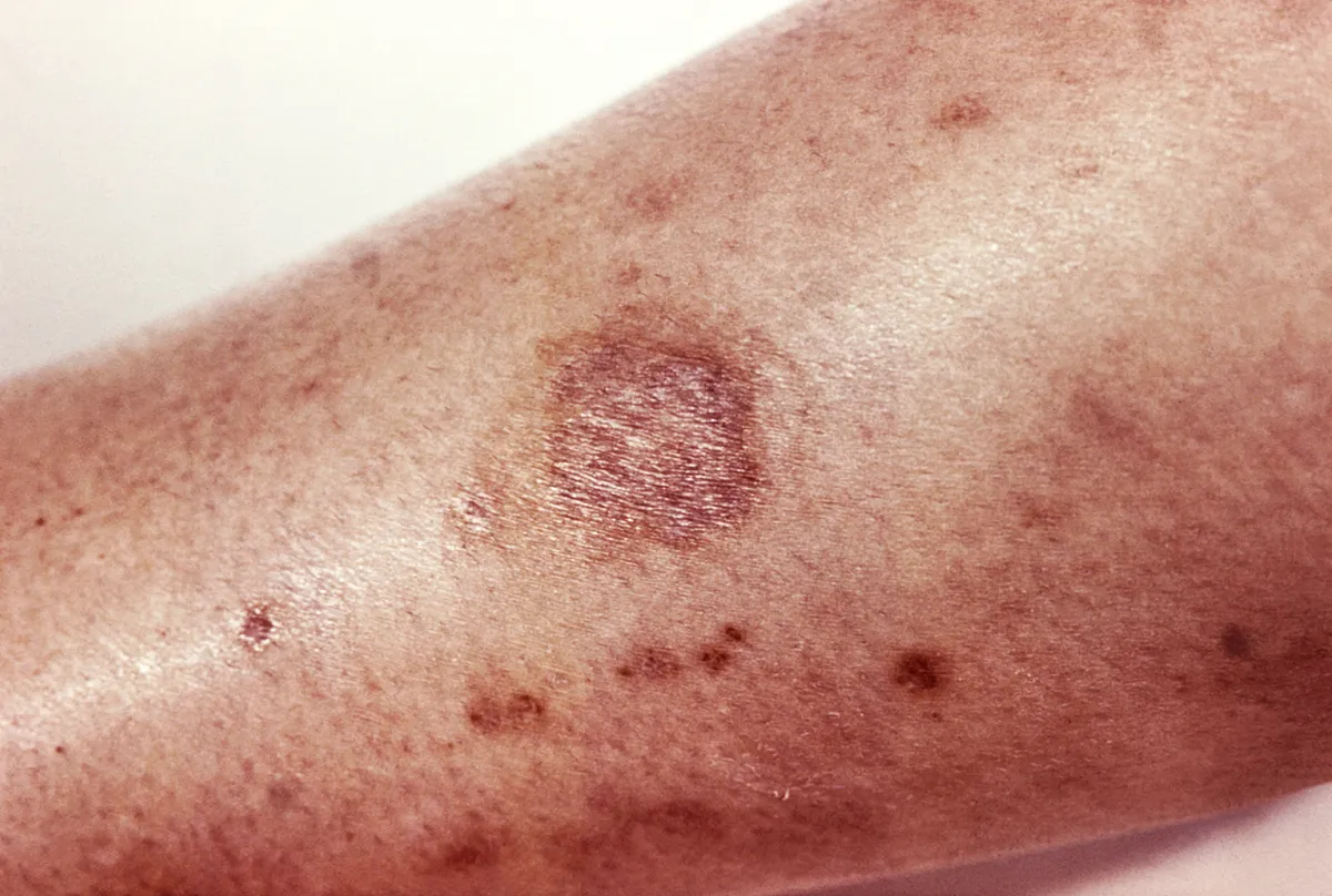 Round patch of dark reddish-brown, damaged skin on the inside of a person's calf, with a few smaller dark spots on the skin around it
