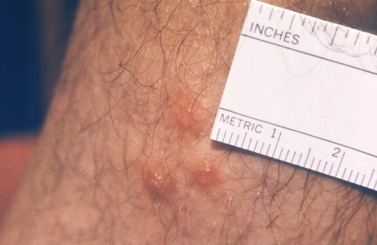 Three small red welts from chigger bites on a hairy arm, next to a paper ruler marked in inches and metric units