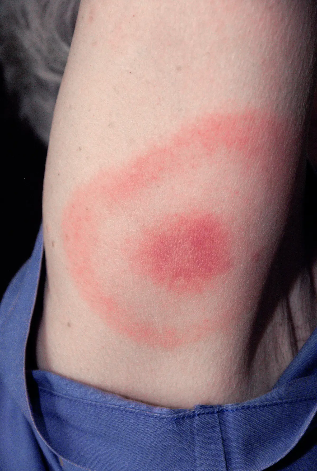 Lyme disease rash in a bull's-eye pattern on the back of a person's upper arm: a red centre, a paler ring and a wide outer red ring
