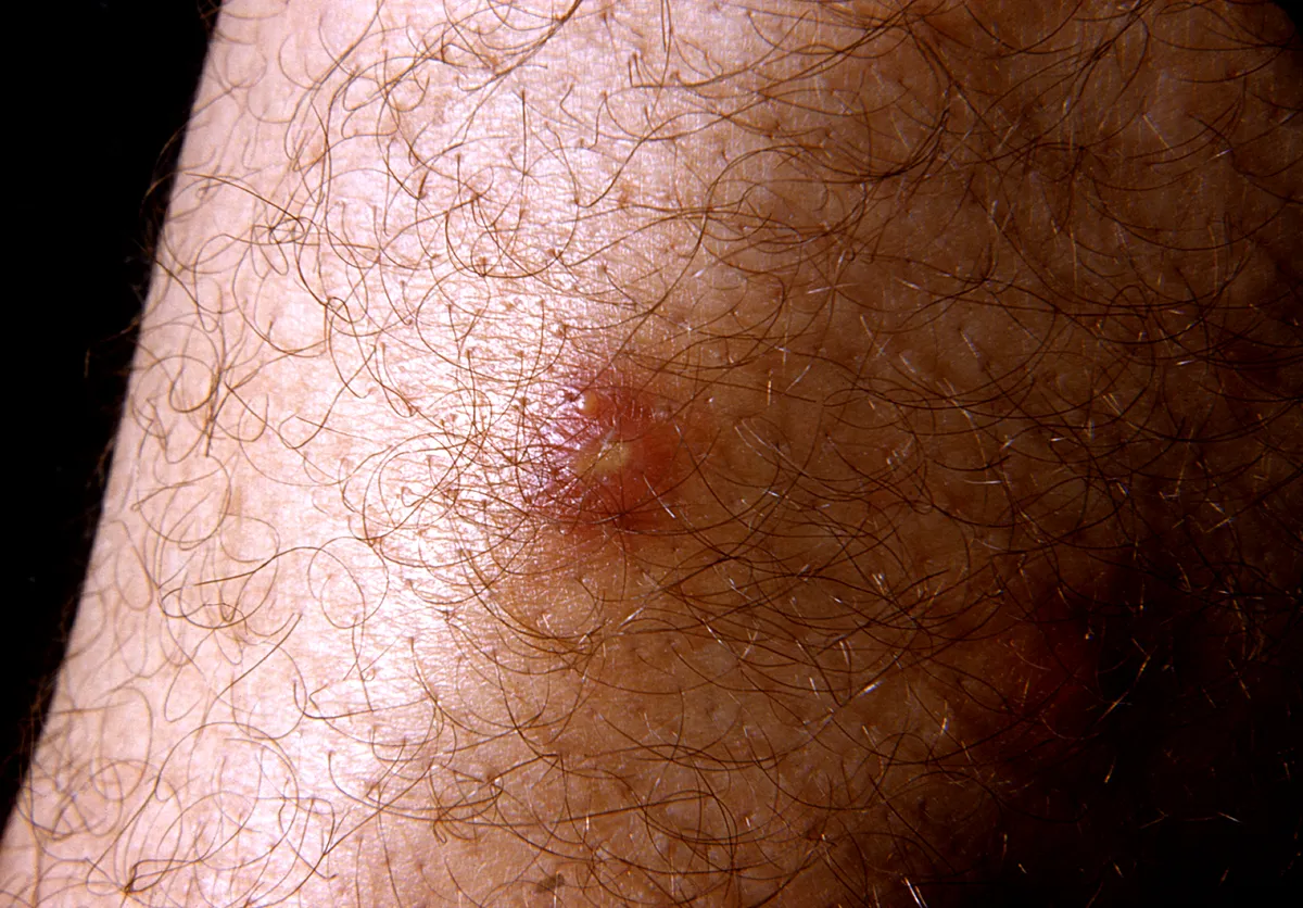 Close view of hairy skin on a leg with a small whitish pustule ringed by red, inflamed skin.