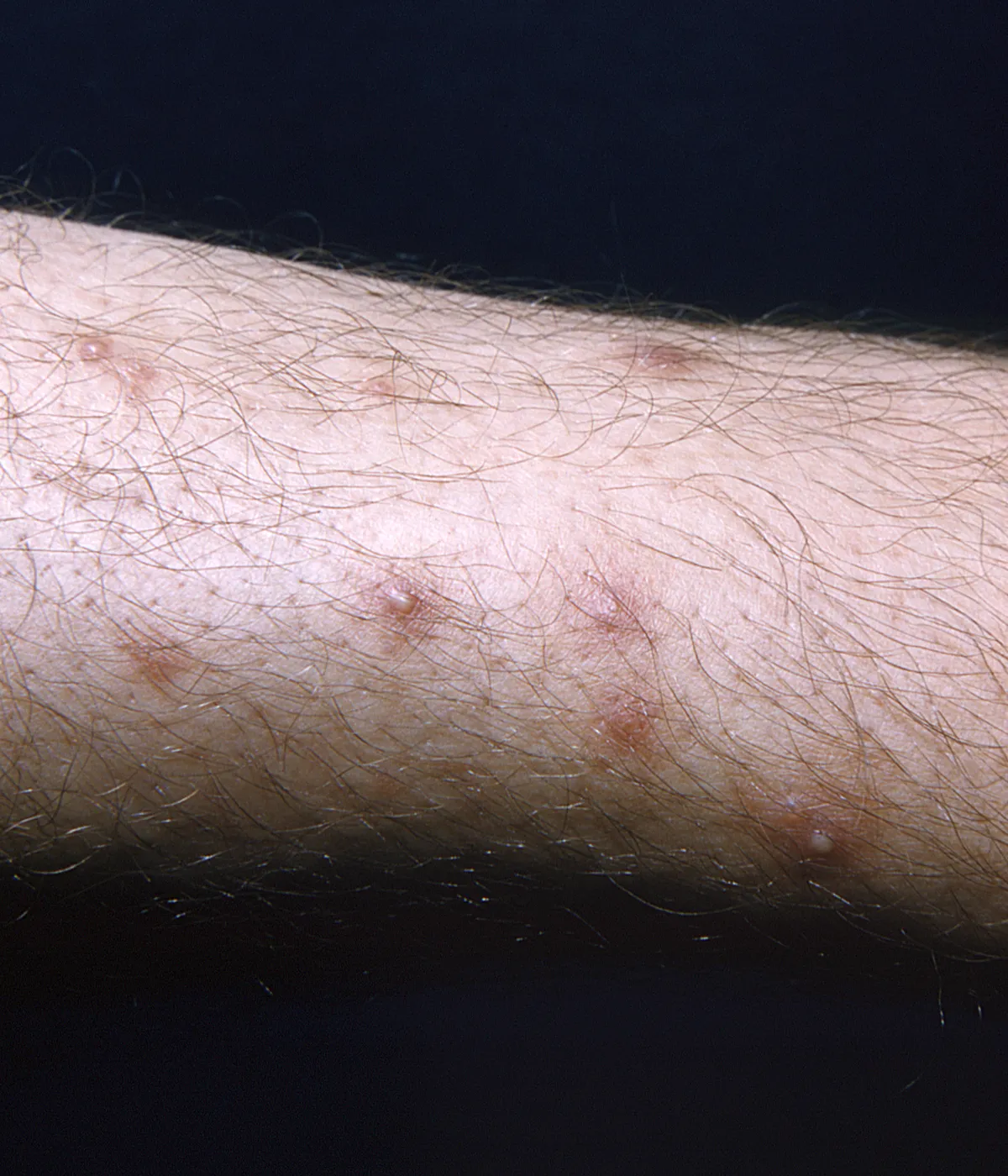 Hairy forearm against a black background with a scattering of small pink spots, several topped with tiny pale pustules