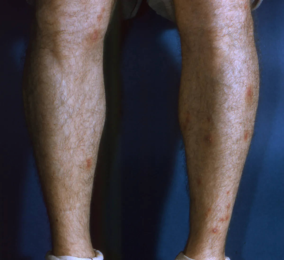 Front view of a man's two lower legs against a dark blue backdrop, scattered with small red spots, a few of them with pale centers