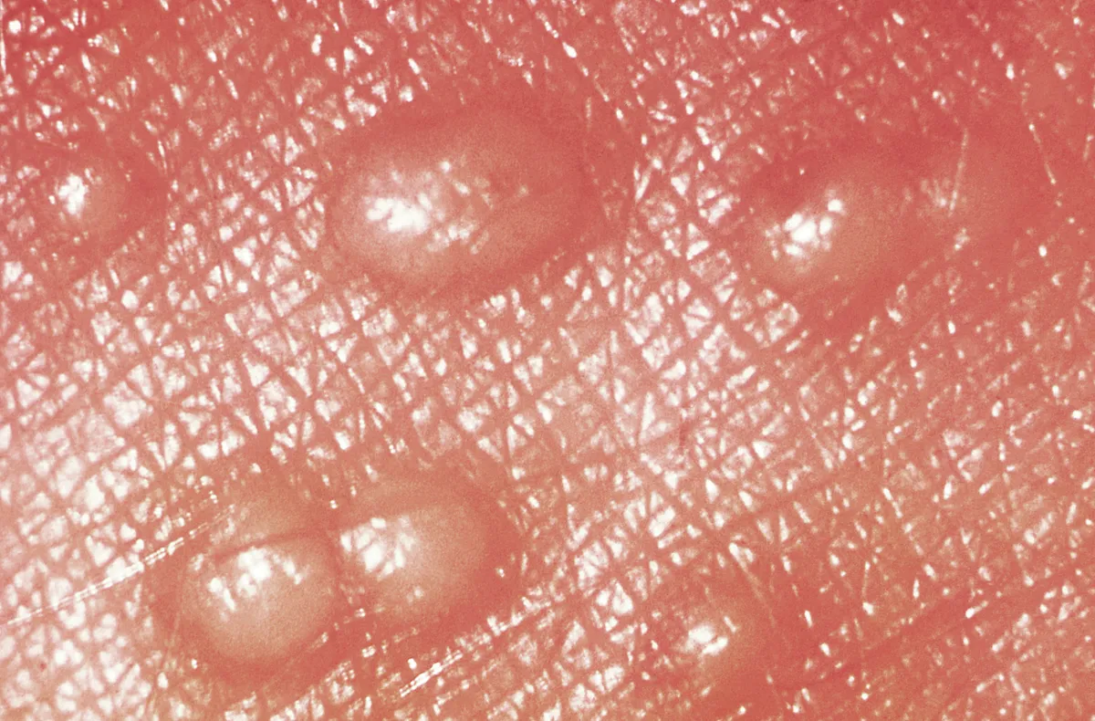 Close-up of reddened skin with several raised, shiny, pale bumps, the fine crease lines of the skin visible around them