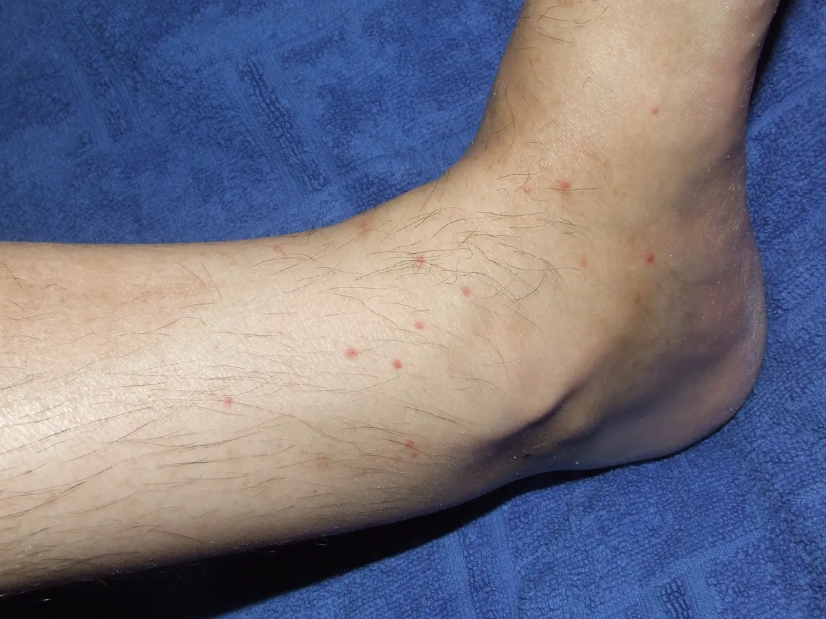 Many small red dots scattered over a lower leg and ankle resting on a blue towel.