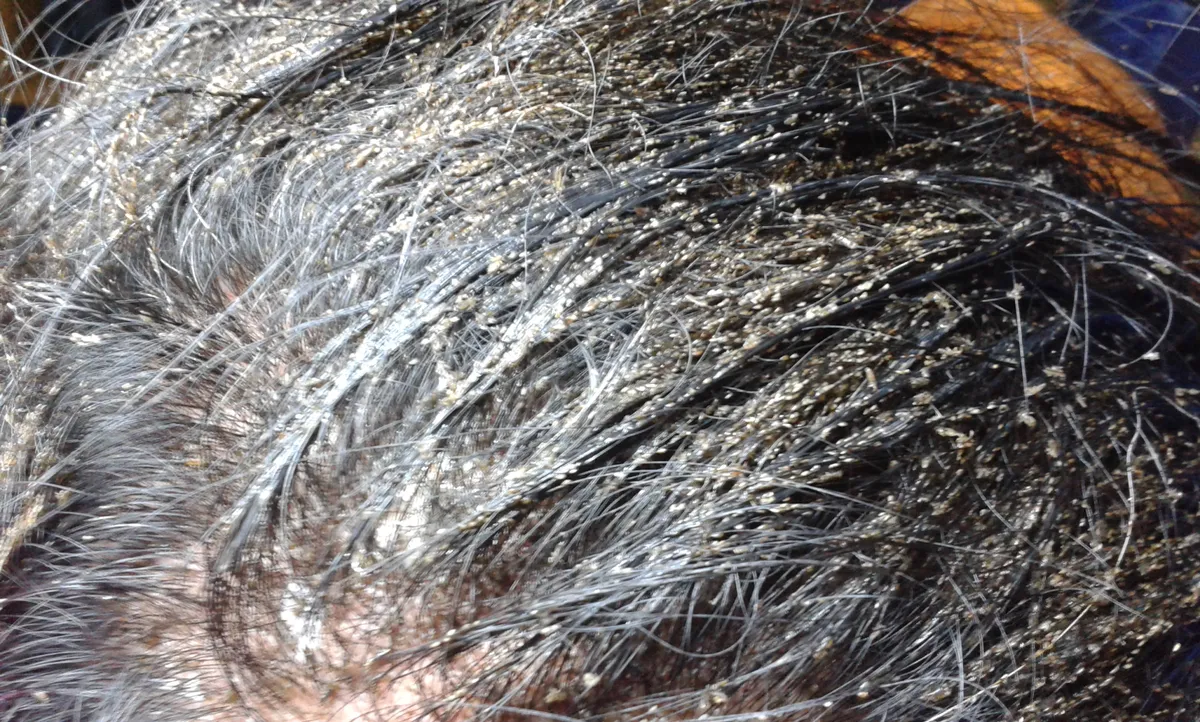 Dark hair seen from above, crowded with thousands of small tan and whitish oval specks stuck along the hair shafts