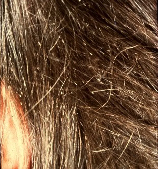 Brown hair seen without magnification, with many small pale specks stuck to individual hairs and skin at the lower left