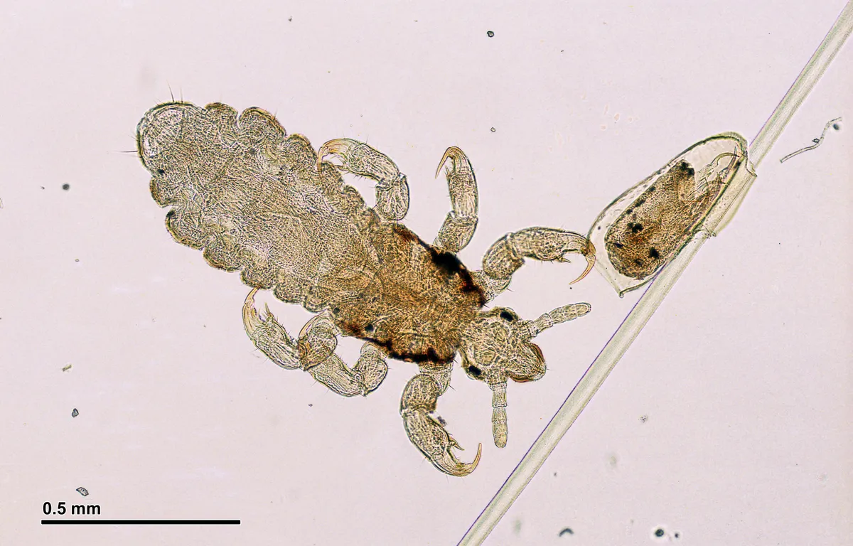 Magnified adult head louse with six clawed legs on a microscope slide, beside a much smaller oval egg glued along a single hair