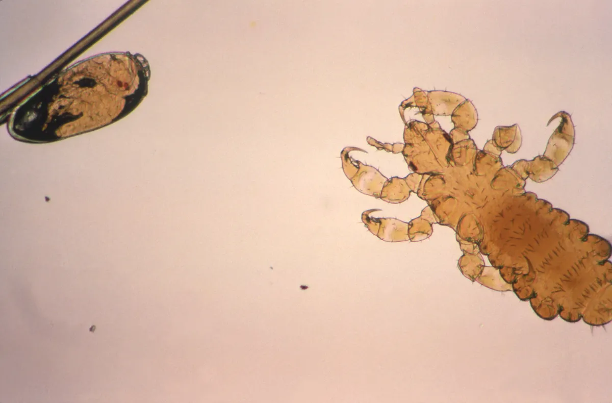 Magnified unhatched louse egg on a hair shaft with two tiny red eyespots visible inside it, and a pale young louse with clawed legs at the right
