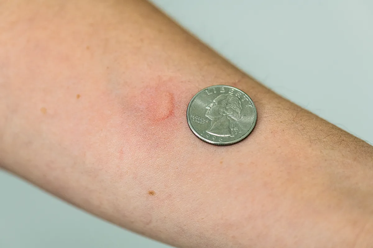 A single raised, reddened welt on the inside of a forearm beside a U.S. quarter for scale