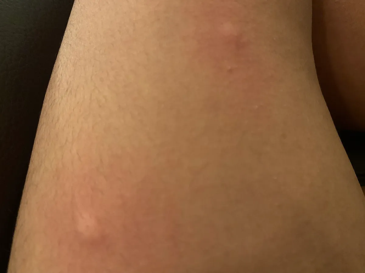 Two faint, raised pinkish welts on the skin of a leg, one near the top of the photo and one near the bottom.
