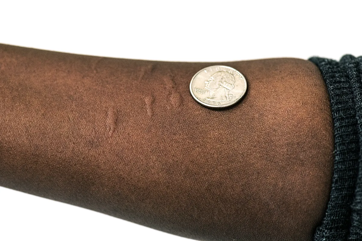 Several faint, raised mosquito bite welts on the inside of a forearm beside a US quarter for scale