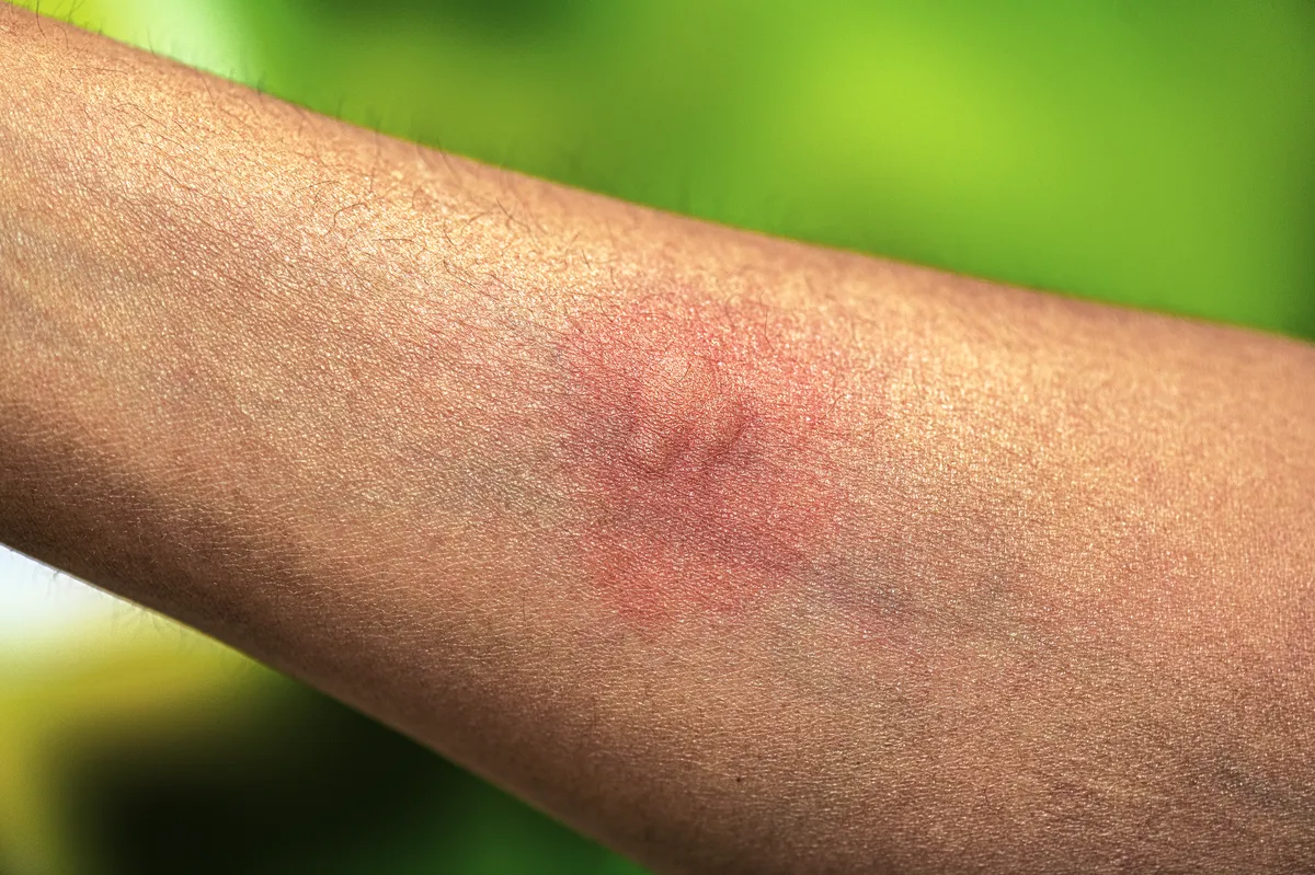 Inside of a forearm with a raised, reddened patch where several swollen mosquito bites have run together, against a blurred green background