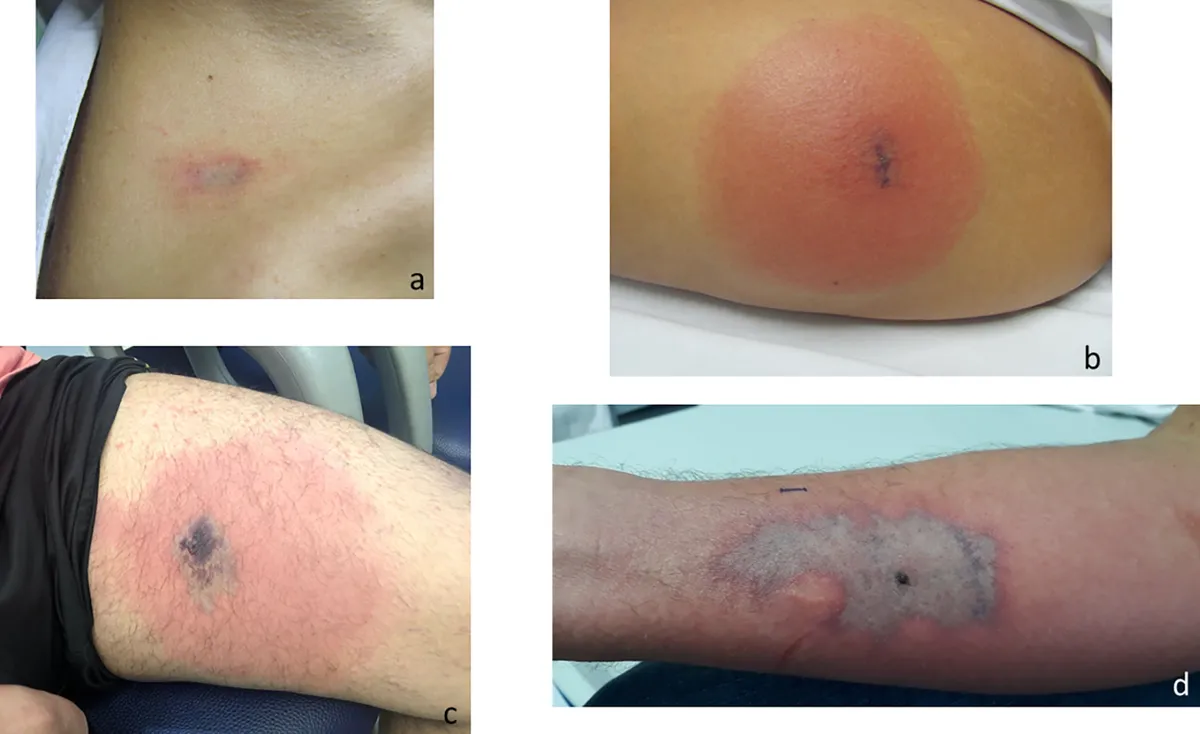 Four lettered clinical photos of recluse bites: a faint pink patch with a pale center, a round red area with a small dark mark, a red thigh patch with a purple blotch, and a gray-purple patch on a forearm