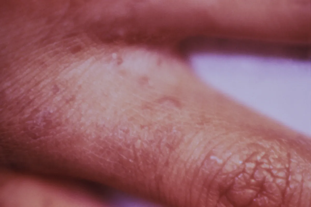 Close view of the skin between two fingers with small raised pinkish bumps of a scabies rash