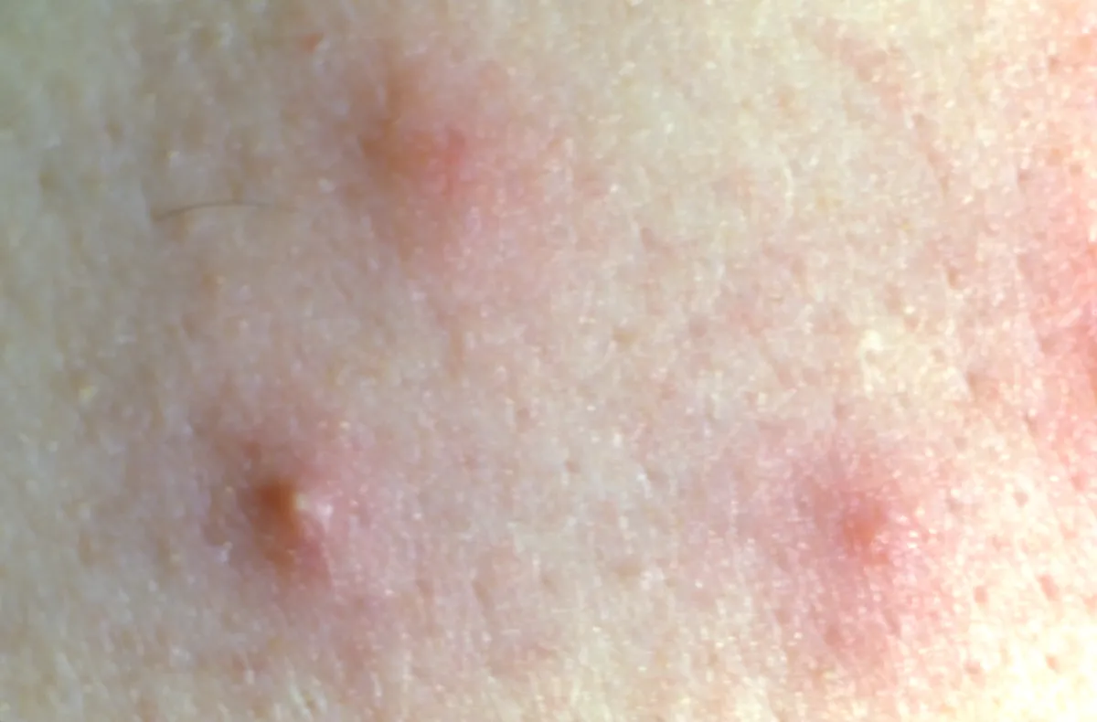 Close view of pale skin on a person's back with three small, raised pink bumps, each with a tiny darker spot at its center
